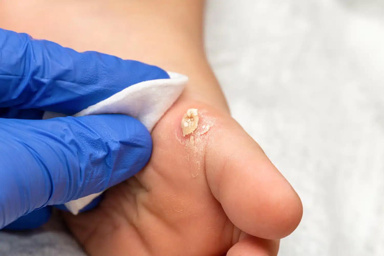 Cryosurgery for wart treatment