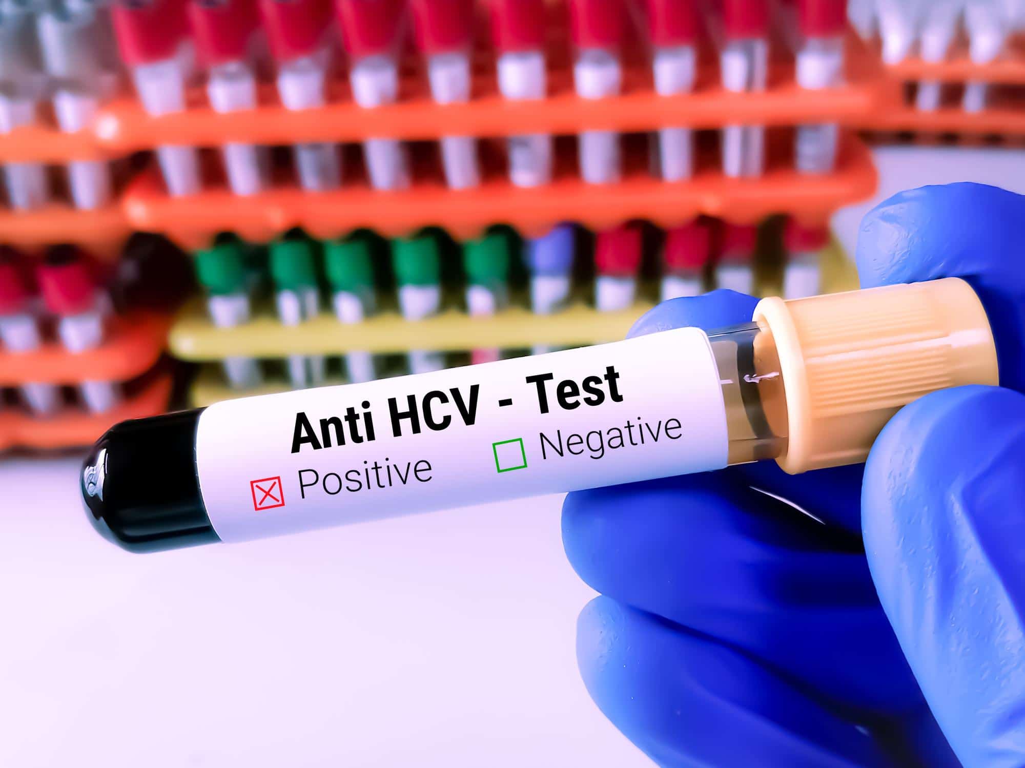 Anti HCV Hepatitis C testing