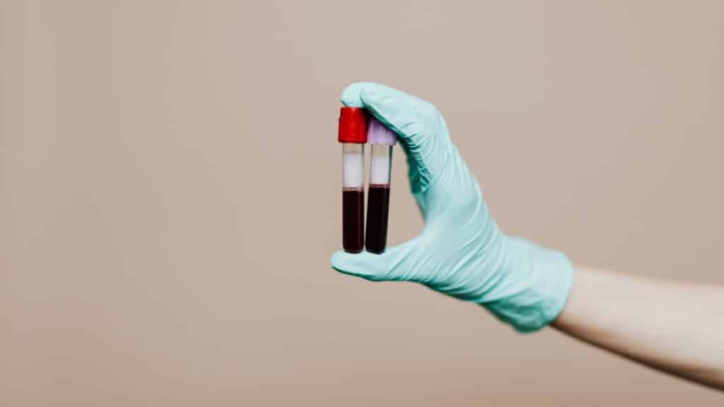 How Often Should You Get an STD Test