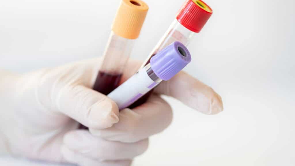 Typical Blood-Test Timeline
