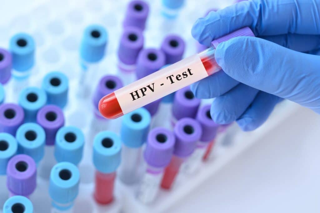 Doctor holding an HPV test blood sample tube for HPV symptoms screening in a laboratory