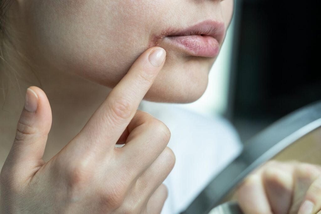 Woman checking cold sores on her lips, a symptom of herpes simplex virus HSV-1.