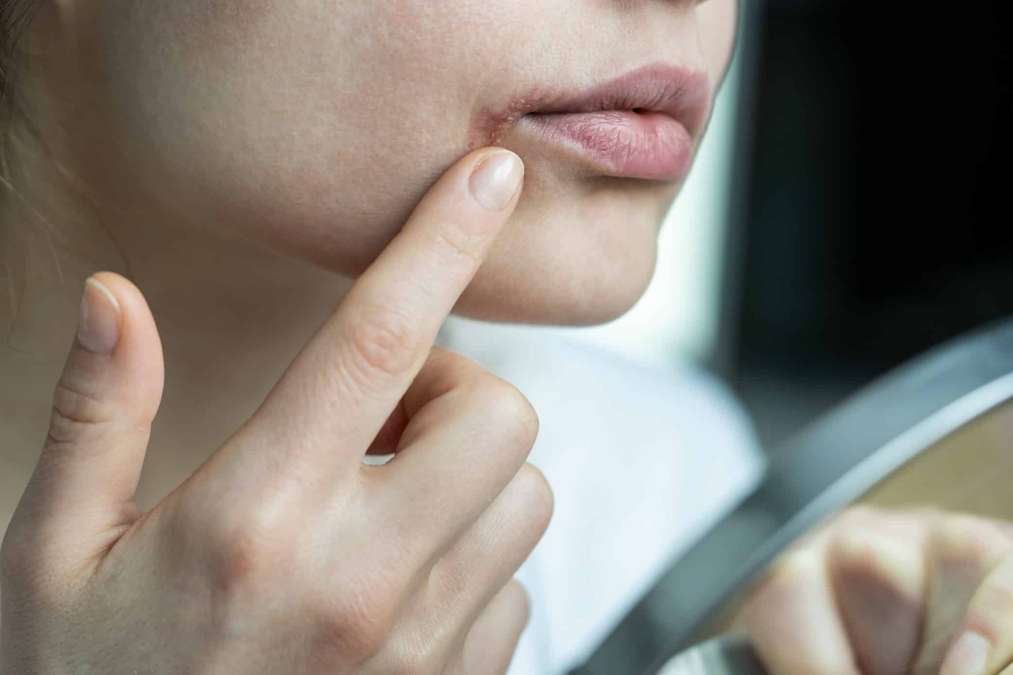 Woman checking cold sores on her lips, a symptom of herpes simplex virus HSV-1.