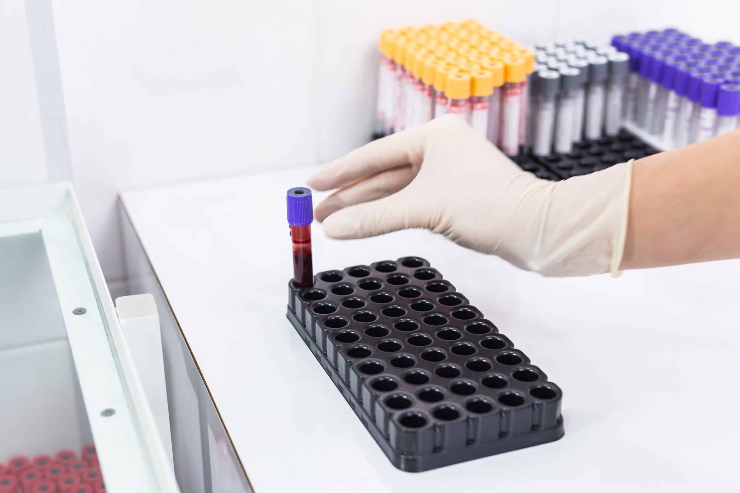 Laboratory technician handling a blood sample for hormone testing