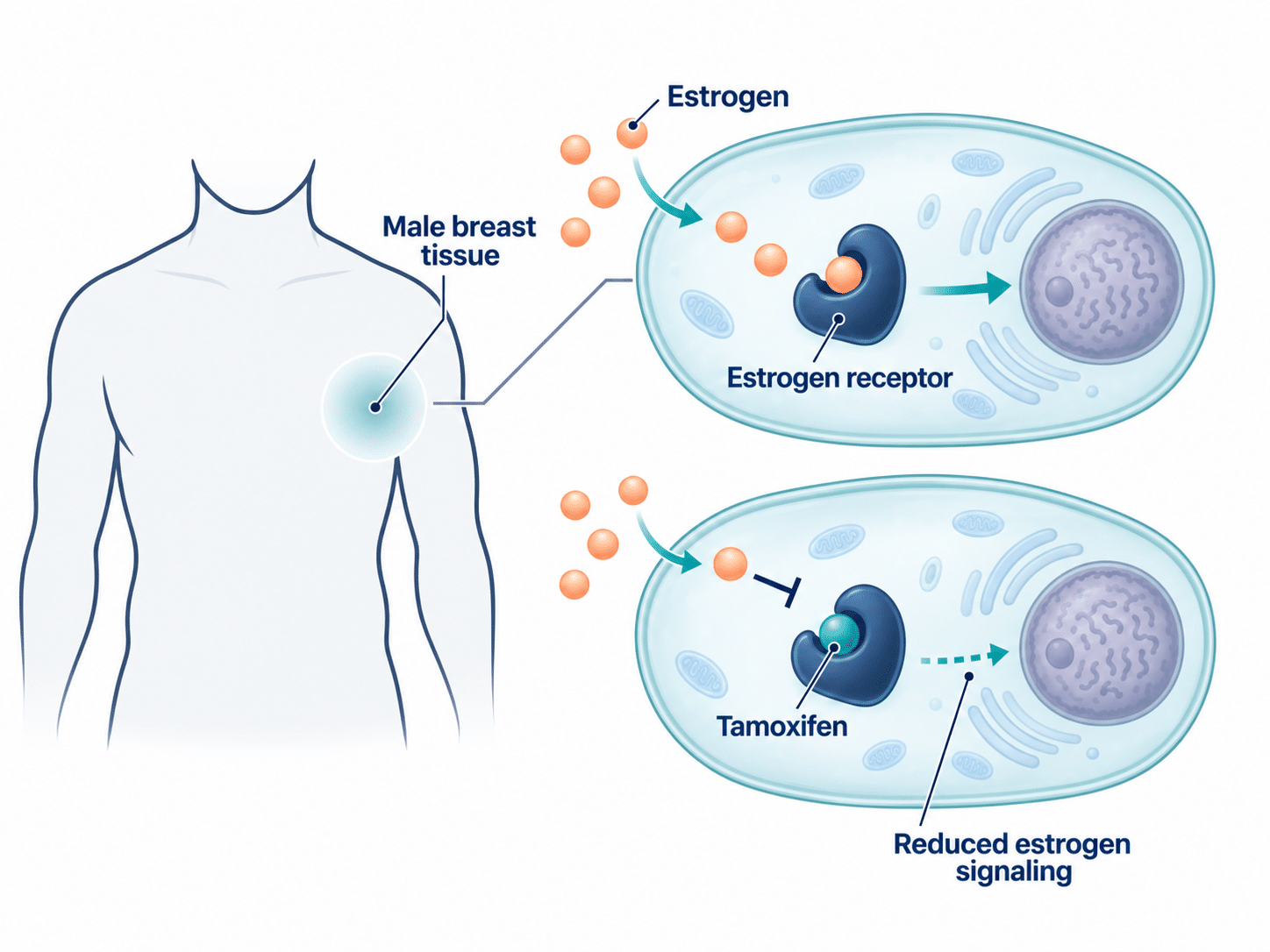 Medical illustration showing tamoxifen occupying an estrogen receptor and reducing estrogen signaling in male breast tissue.